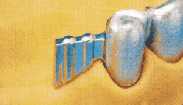 Vario Soft Free End saddles